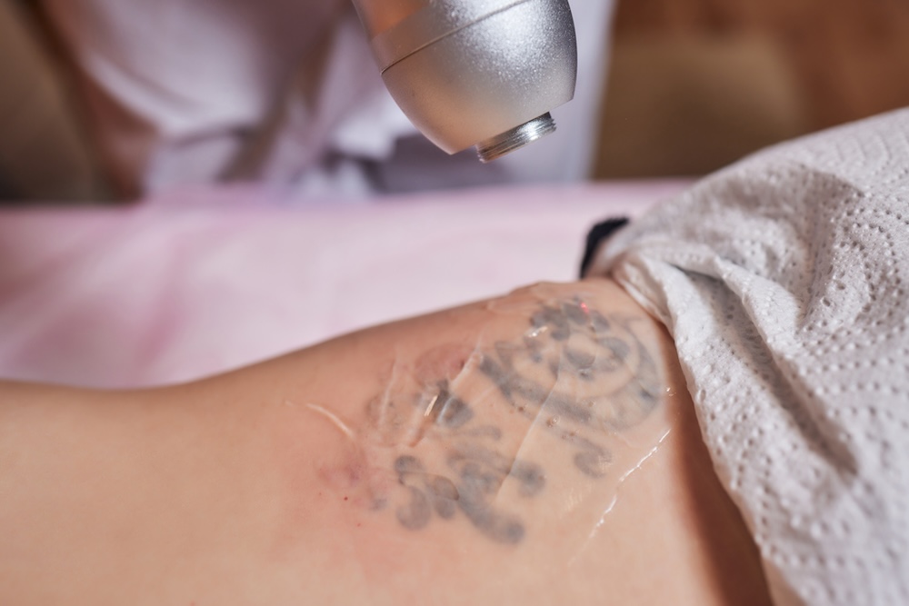 Young woman undergoing laser tattoo removal procedure in salon, closeup